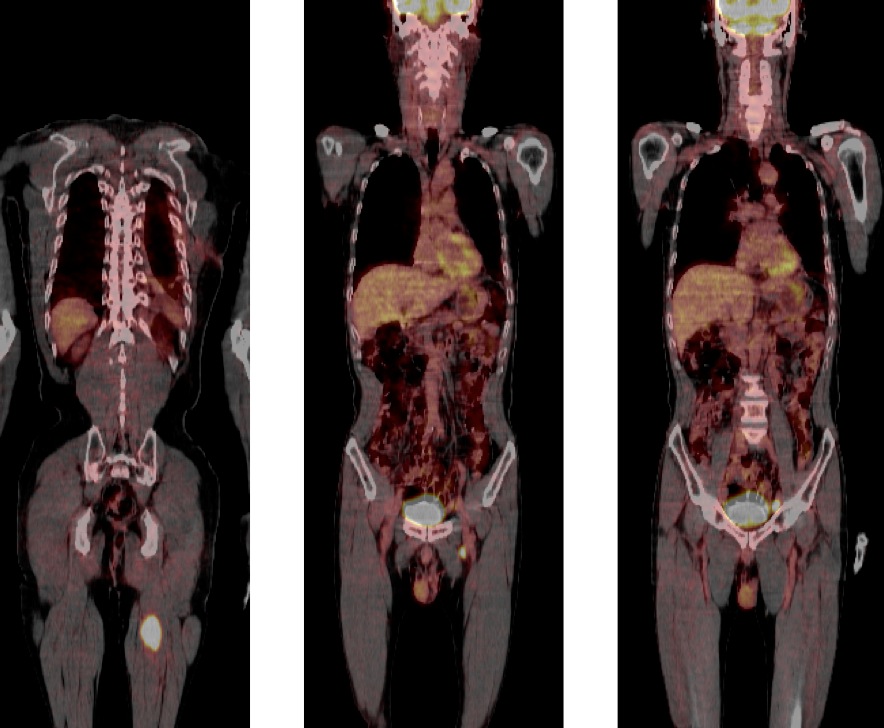 Figure 5 for case Adenocarcinoma lung metastasis